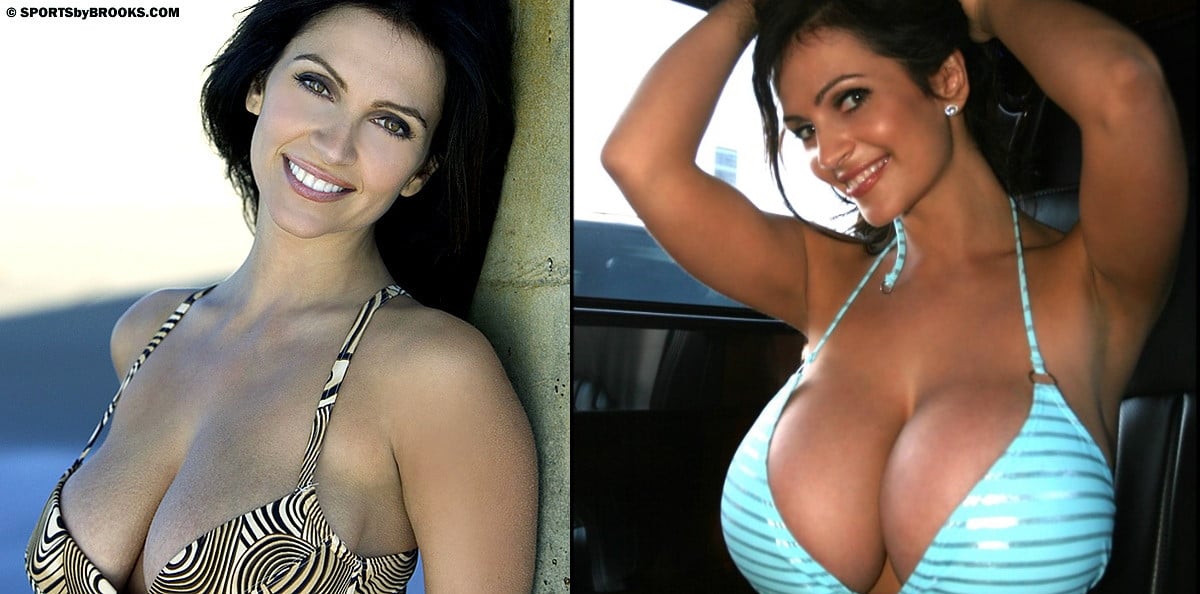 Denise Milani before and after breast enlargement